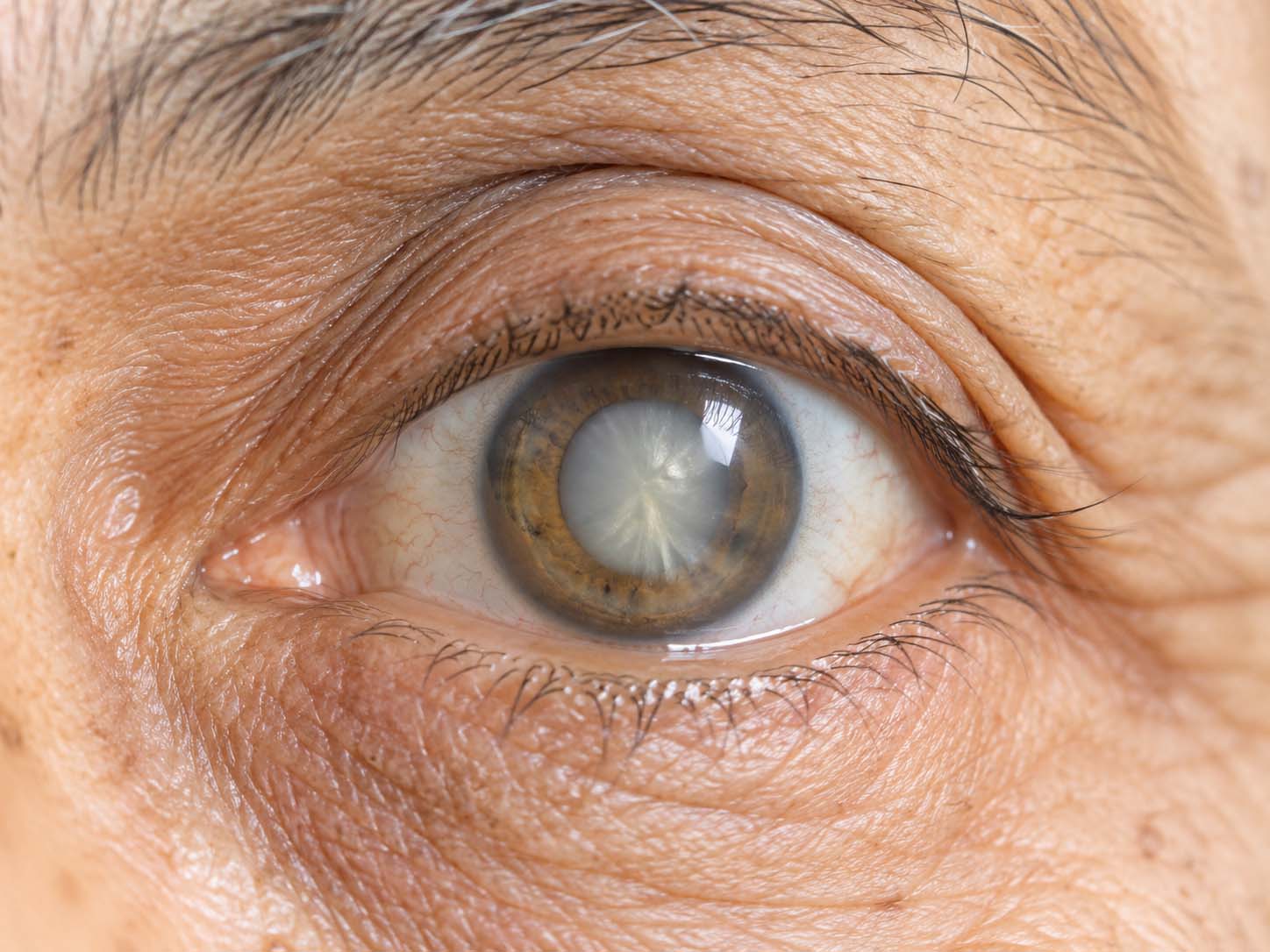 Cataract